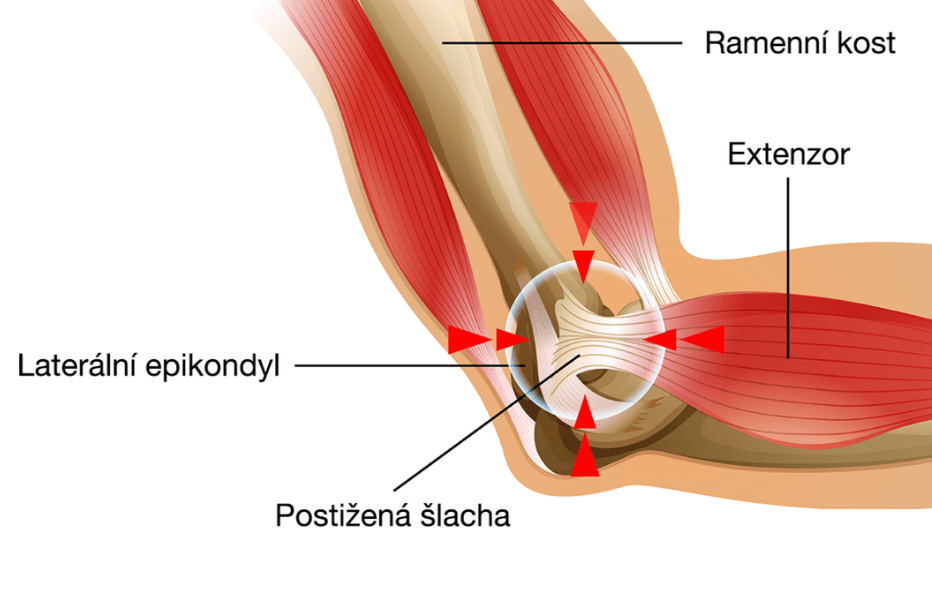 anatomie tenisového lokte